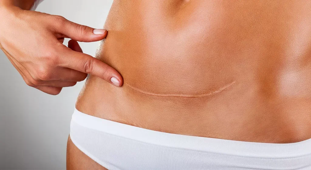 tummy tuck scar-Management of Scarring
